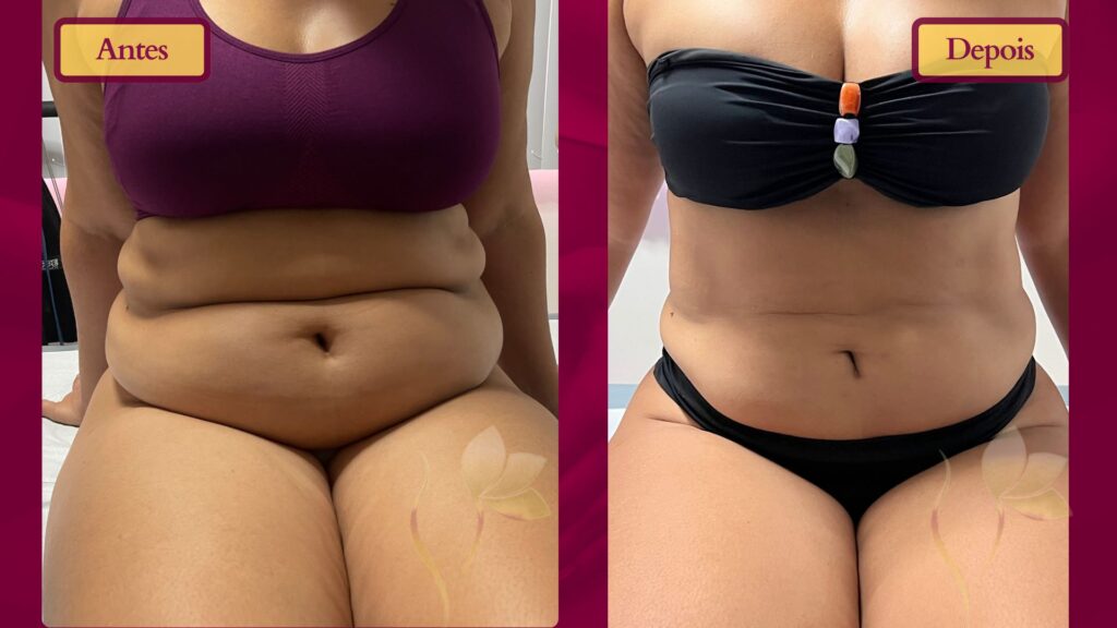 Antes e depois de uma paciente tratada com CrioDefinição. Usamos o equipamento da criolipólise com a técnica da Crioescultura associada ao Diástase Reset, para devolver competência à musculatura abdominal.