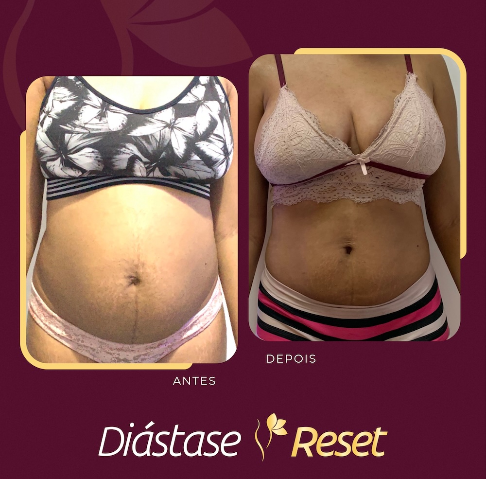 Resultado do Diástase Reset, tratamento de abdômen.