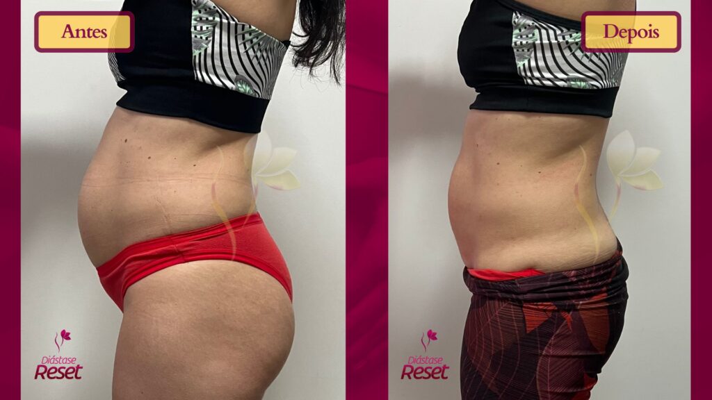 Diástase abdominal tratada sem cirurgia com exercícios e fisioterapia
