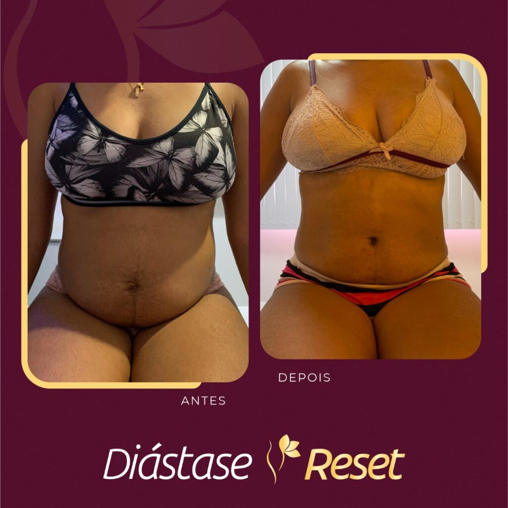 Diástase Reset - Resultado de tratamento sem cirurgia