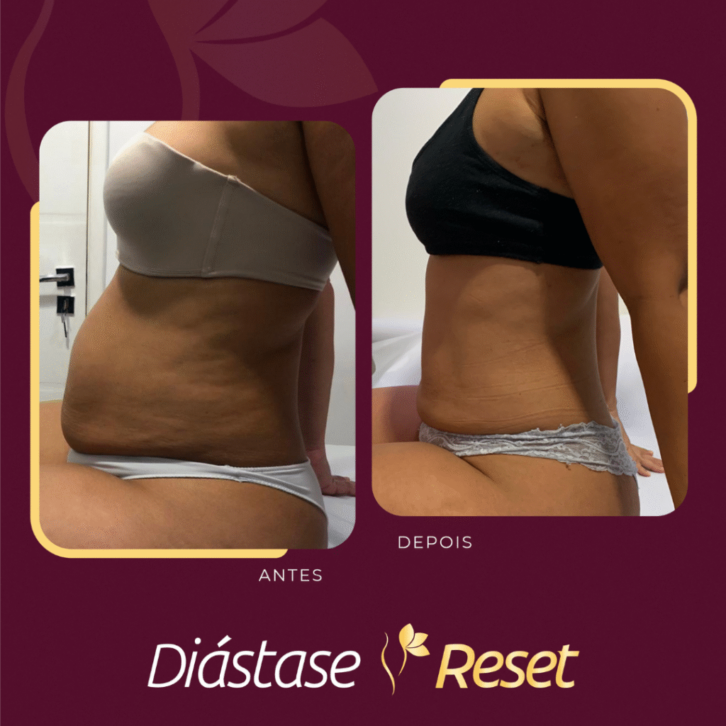 Diástase Reset - Resultado de tratamento sem cirurgia