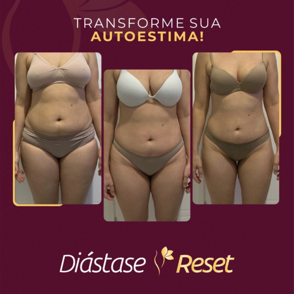 Diástase Reset - Resultado de tratamento sem cirurgia