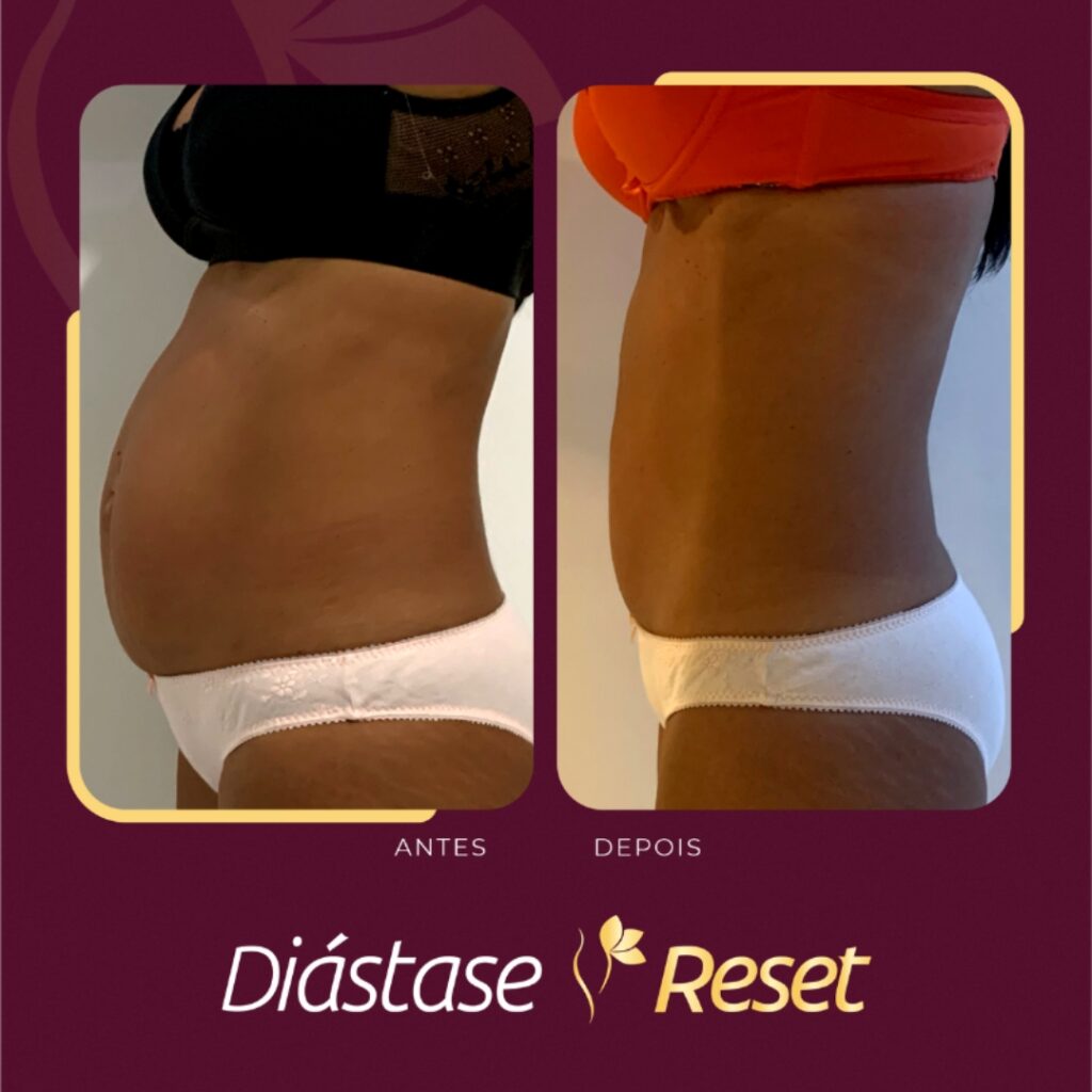 Diástase Reset - Resultado de tratamento sem cirurgia