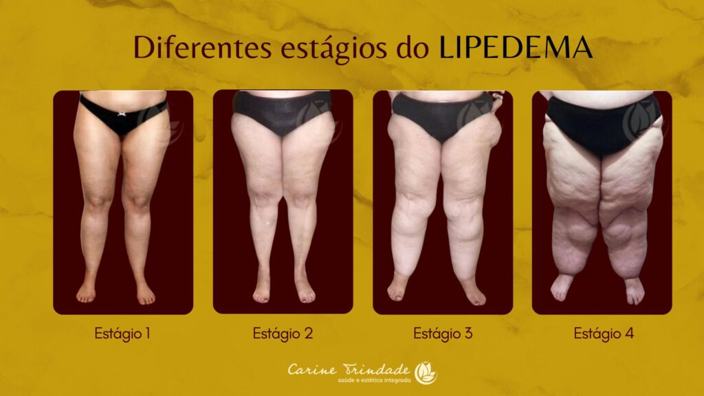 O lipedema nas pernas pode progredir atingindo, na maioria dos casos, a região entre quadril e joelhos. Mas pode chegar aos pés e tornozelos.