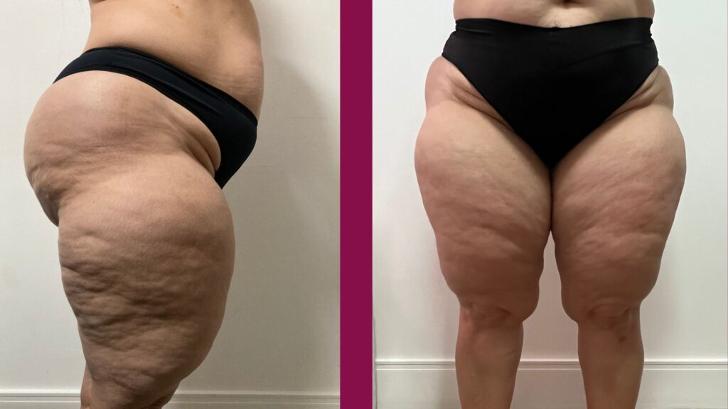 Lipedema nas pernas pode ser confundido com celulite ou gordura localizada.