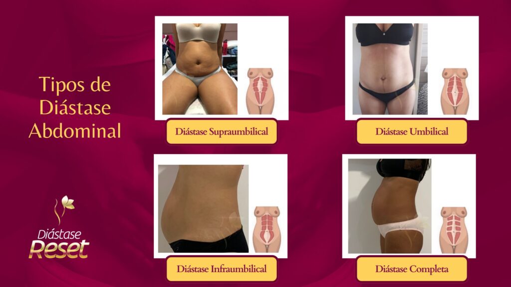 Tipos de diástase abdominal: umbilical, supraumbilica (estômago alto)l, infraumbilical (pochete) e completa ou total (barriga de grávida).