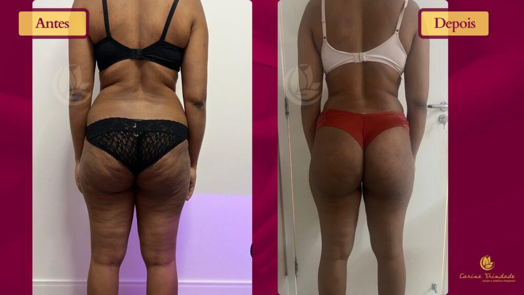 Resultado de tratamento de lipedema nas pernas, quadril e culote, feita na Clínica Crine Trindade.